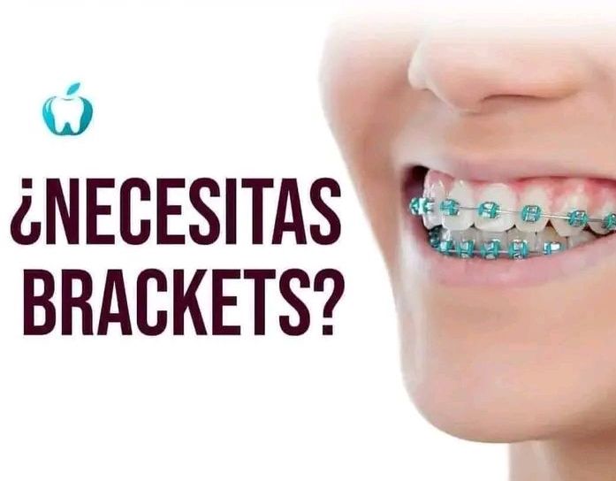 Detalle de sonrisa con brackets de ortodoncia