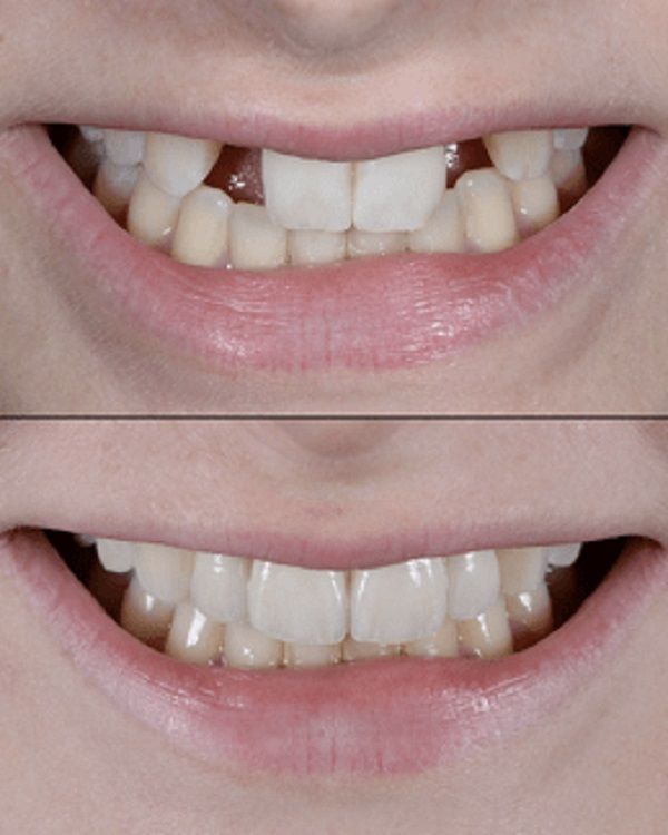 Estética Dental