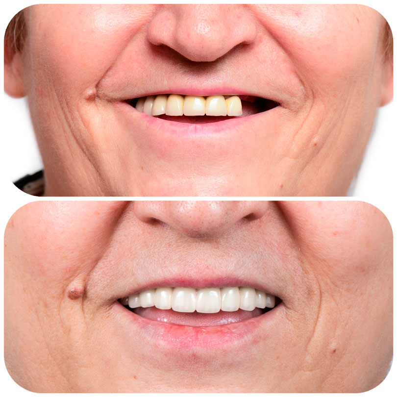 Implantes Dentales